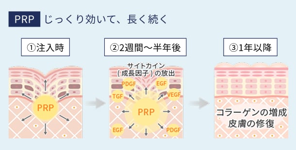 PRP:じっくり効いて、長く続く