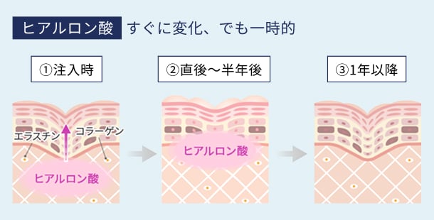 ヒアルロン酸:すぐに変化、でも一時的