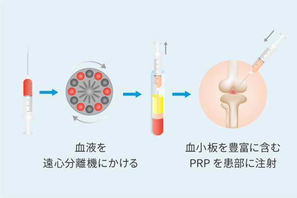 血液を遠心分離機にかける→血小板を豊富に含むPRPを患部に注射